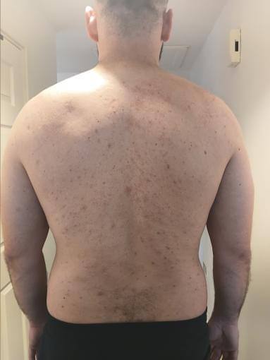 BioRePeel pigmentation skin clarity results at Revitalise Aesthetics Liverpool BioRePeel pigmentation skin clarity results at Revitalise Aesthetics Liverpool