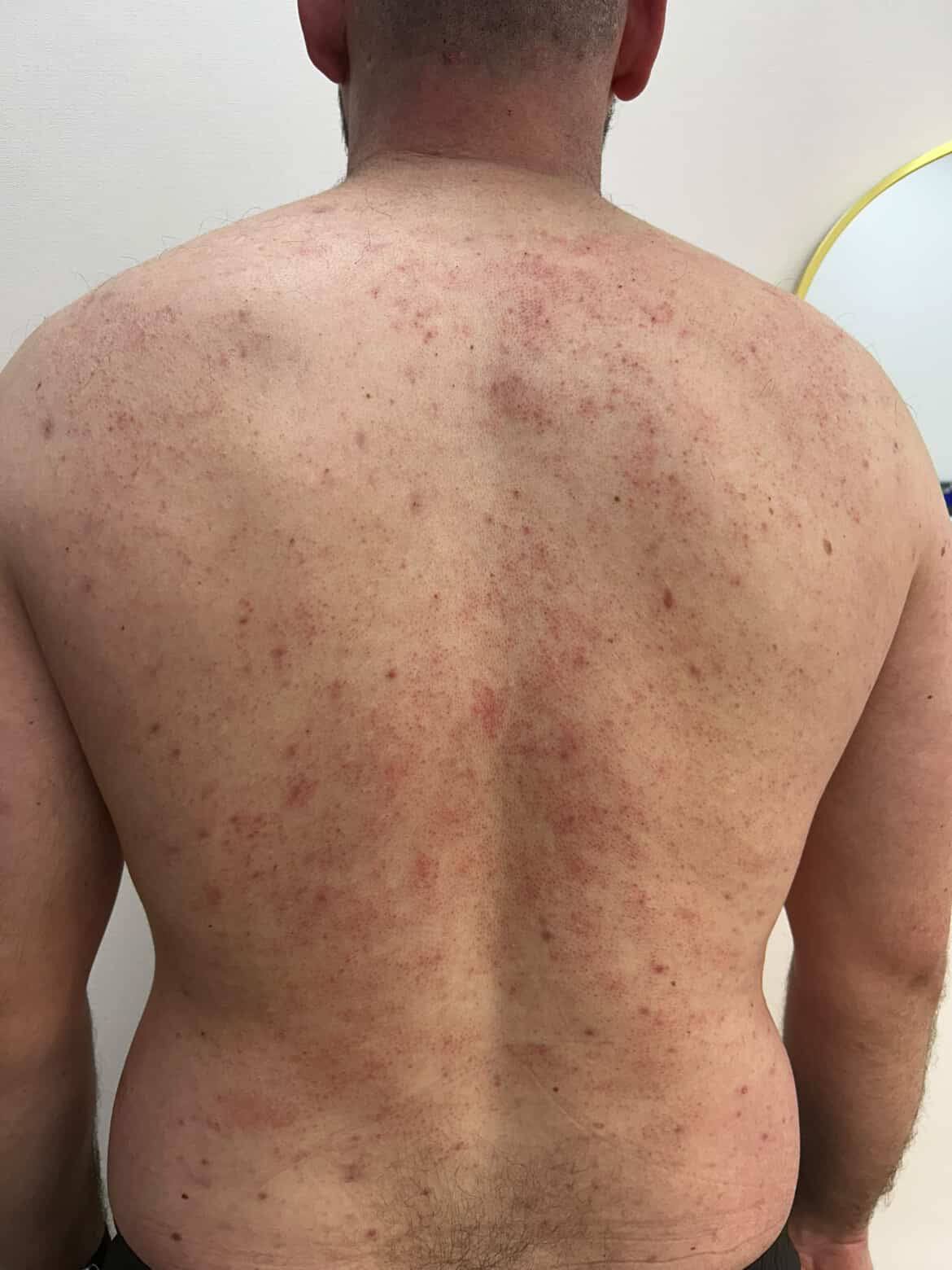 BioRePeel pigmentation before at Revitalise Aesthetics Liverpool BioRePeel pigmentation before at Revitalise Aesthetics Liverpool