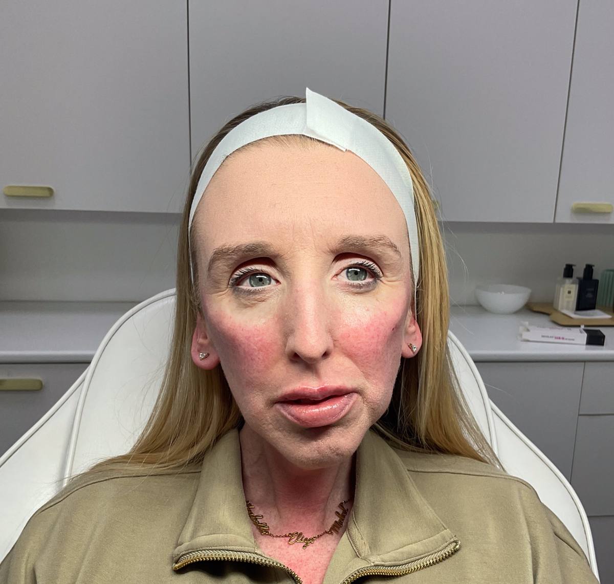 Dermal filler results at Revitalise Aesthetics Liverpool