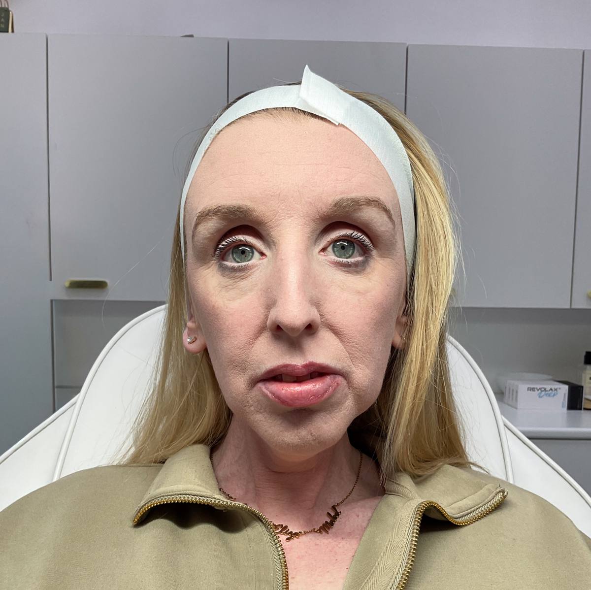 Dermal filler cheek profile balancing before at Revitalise Aesthetics Liverpool