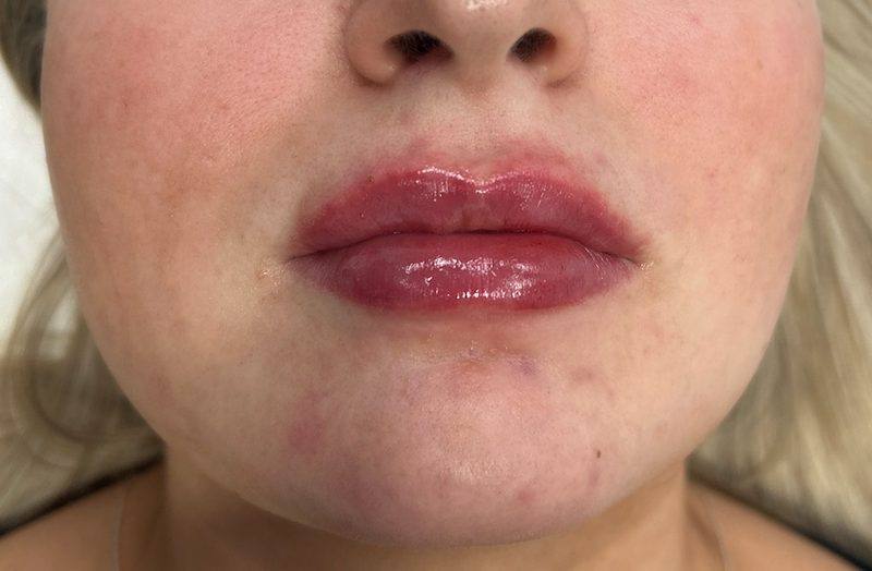 Lip filler results at Revitalise Aesthetics Liverpool