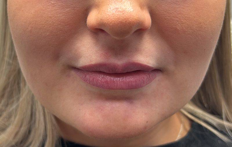 Revitalise Aesthetics Liverpool lip filler before