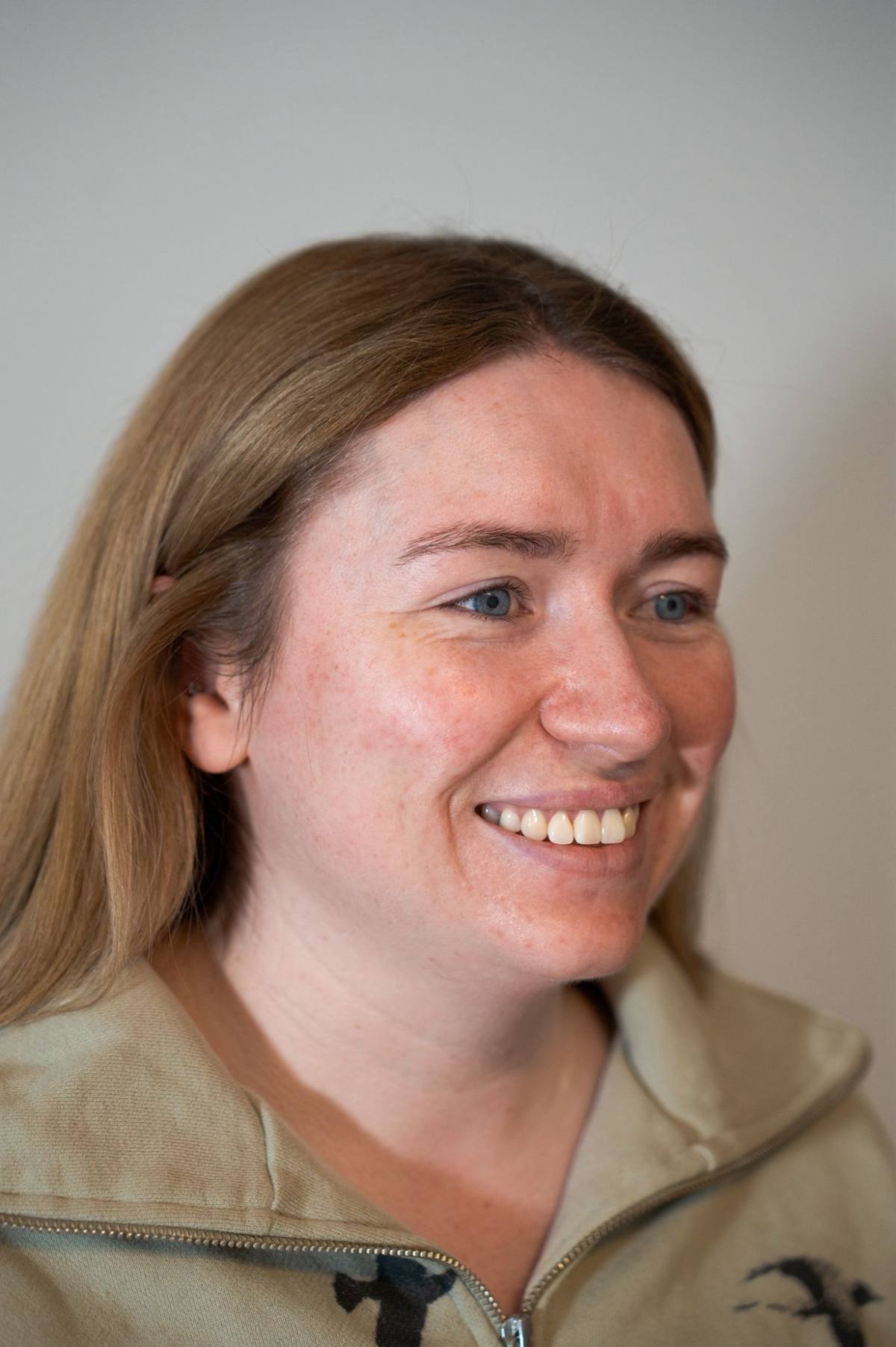 Polynucleotides skin texture results at Revitalise Aesthetics Liverpool Polynucleotides skin texture results at Revitalise Aesthetics Liverpool