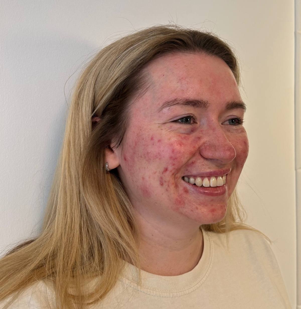 Polynucleotides acne skin texture before at Revitalise Aesthetics Liverpool Polynucleotides acne skin texture before at Revitalise Aesthetics Liverpool