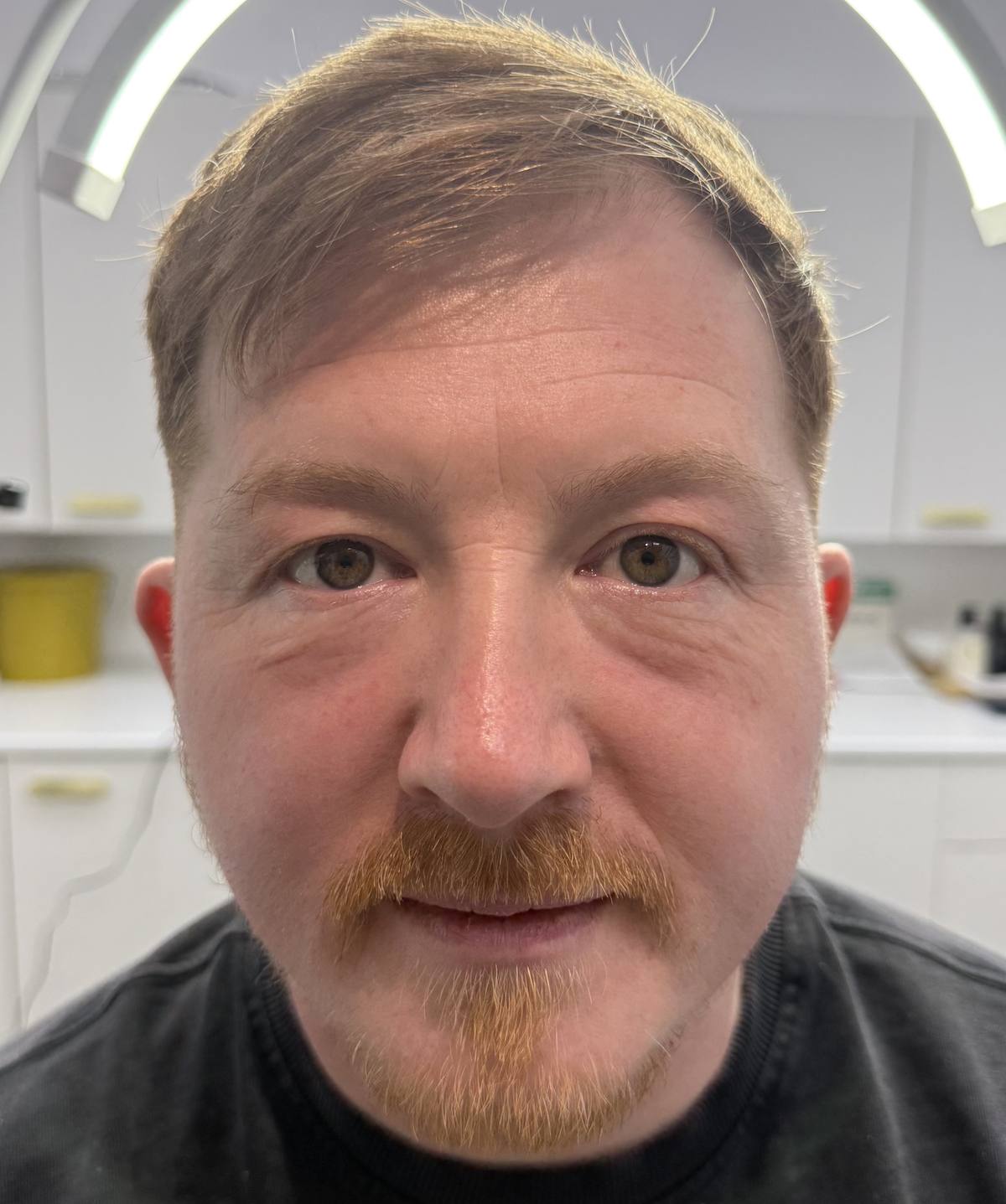 PRP under eye rejuvenation results at Revitalise Aesthetics Liverpool PRP under eye rejuvenation results at Revitalise Aesthetics Liverpool