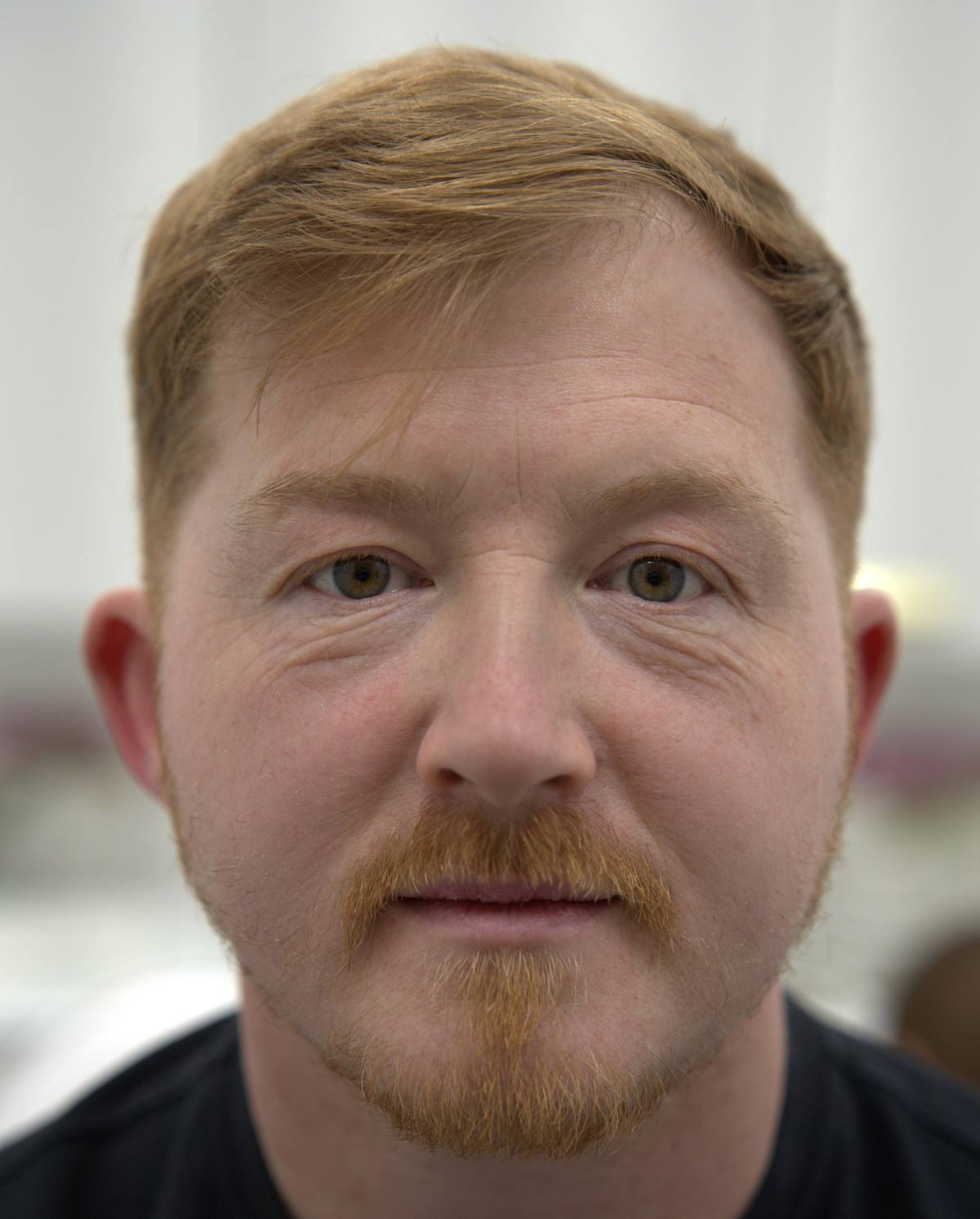 PRP under eye rejuvenation before at Revitalise Aesthetics Liverpool PRP under eye rejuvenation before at Revitalise Aesthetics Liverpool