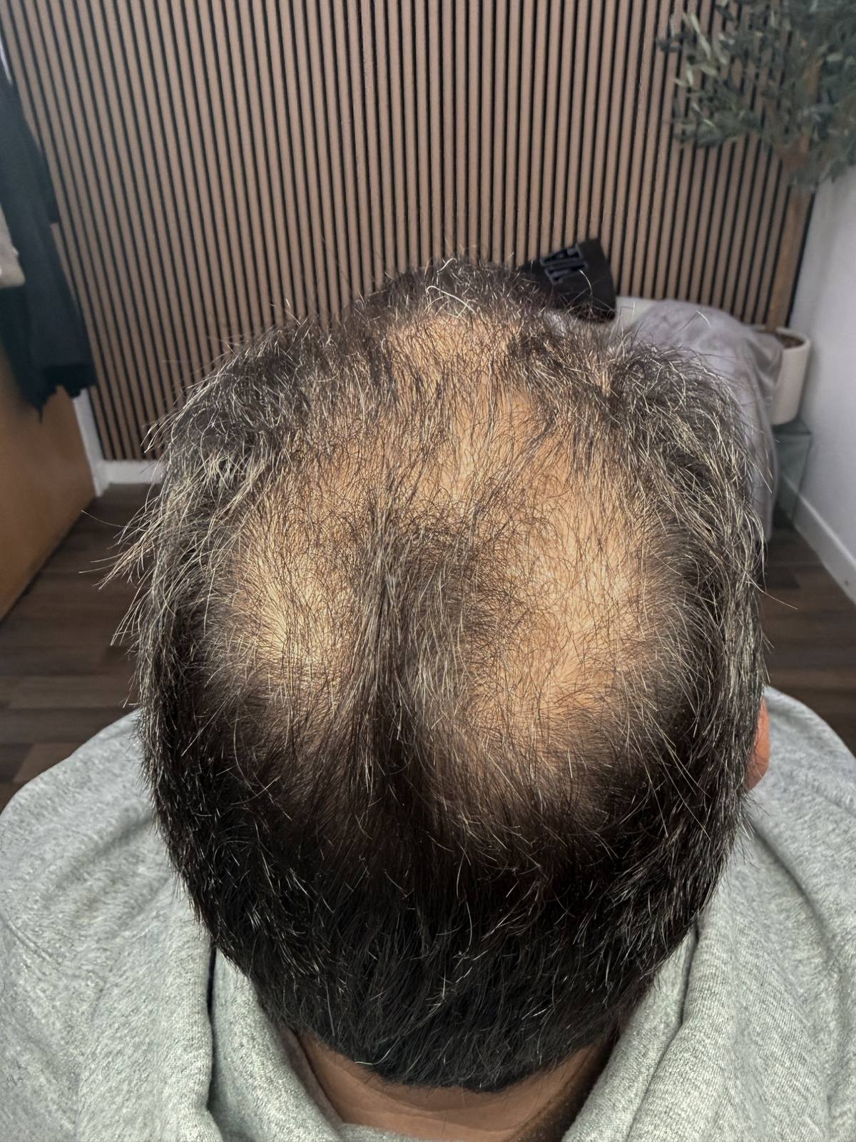 Microneedling scalp hair restoration results at Revitalise Aesthetics Liverpool