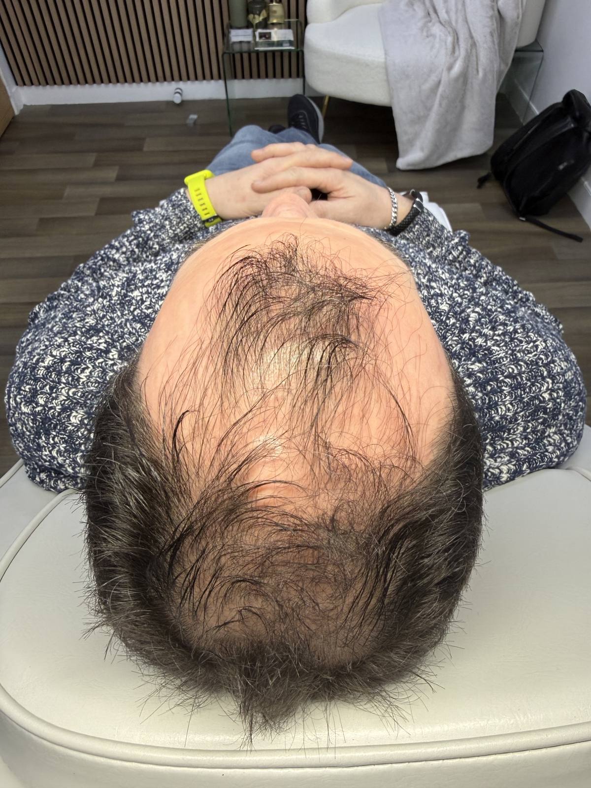 Microneedling scalp hair restoration before at Revitalise Aesthetics Liverpool